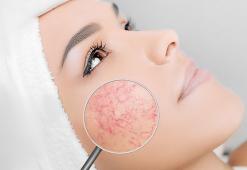 Haut mit Neigung zu Couperose – Charakteristik, Pflege, Kosmetika