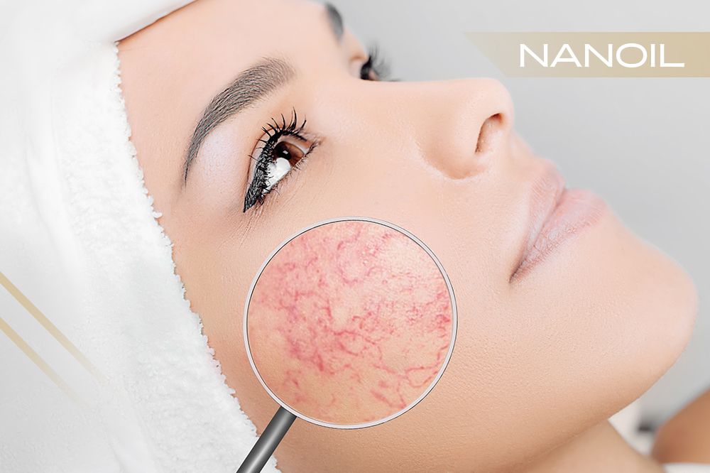 Haut mit Neigung zu Couperose – Charakteristik, Pflege, Kosmetika